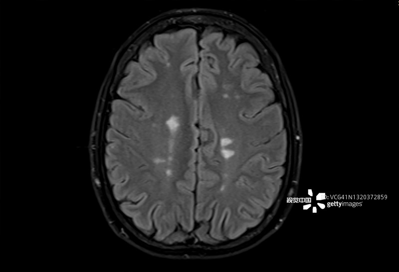 多發(fā)性腦硬化癥的磁共振成像，軸位Flair視圖