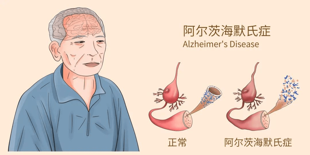 阿爾茨海默病有哪些癥狀丨如何診斷阿爾茨海默??？
