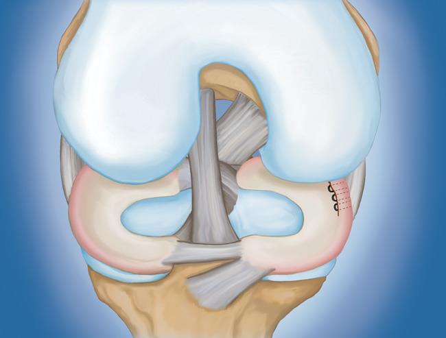 用縫線(xiàn)修復撕裂的半月板