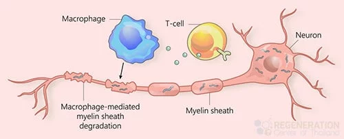 肌萎縮側索硬化癥 (ALS)、運動(dòng)神經(jīng)元疾病 (MND)
