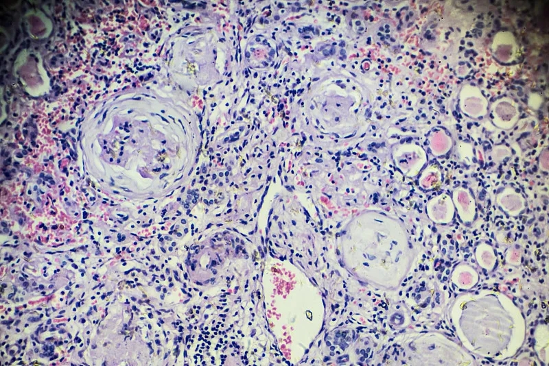 研究：自體干細胞移植對多發(fā)性骨髓瘤、慢性腎病患者安全有效