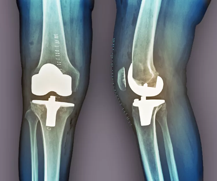 膝骨關(guān)節炎是什么？癥狀、原因和治療