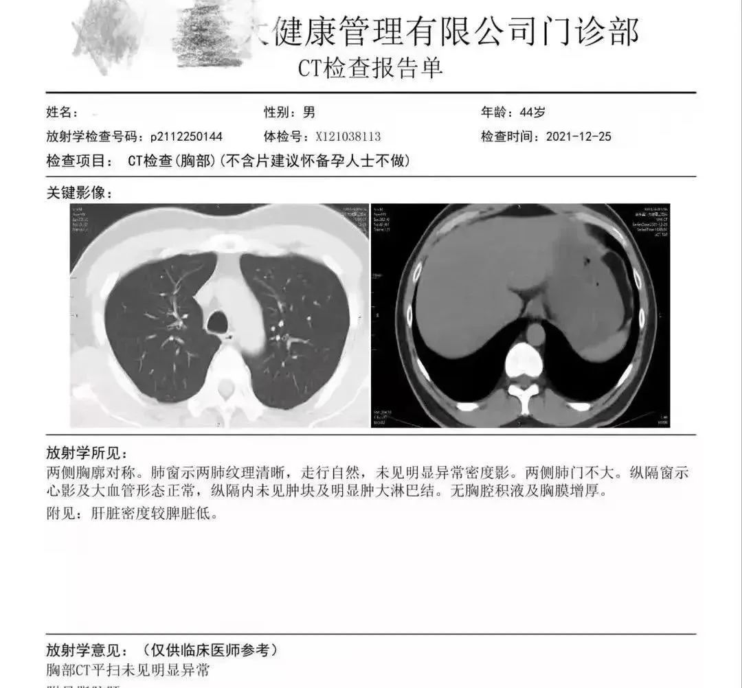 王先生再次復查時(shí)，肺結節已經(jīng)消失。免疫療法不僅僅針對肺癌，胃癌、腸癌等等都可以治療緩解。