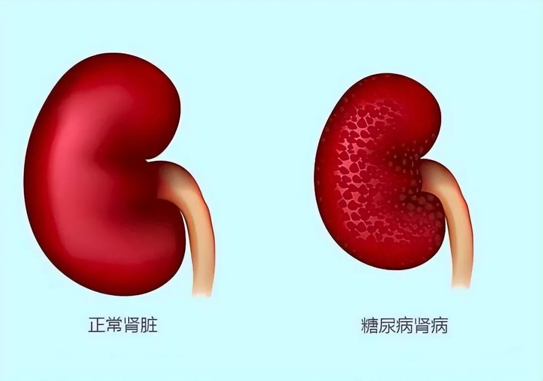 2025年1-12月干細胞治療糖尿病腎病的最新臨床進(jìn)展指南