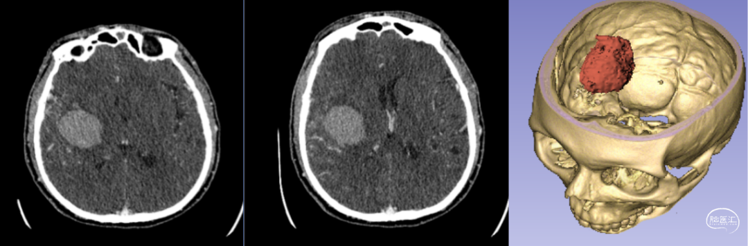 神經(jīng)外科手術(shù)機器人輔助下腦內血腫穿刺術(shù)