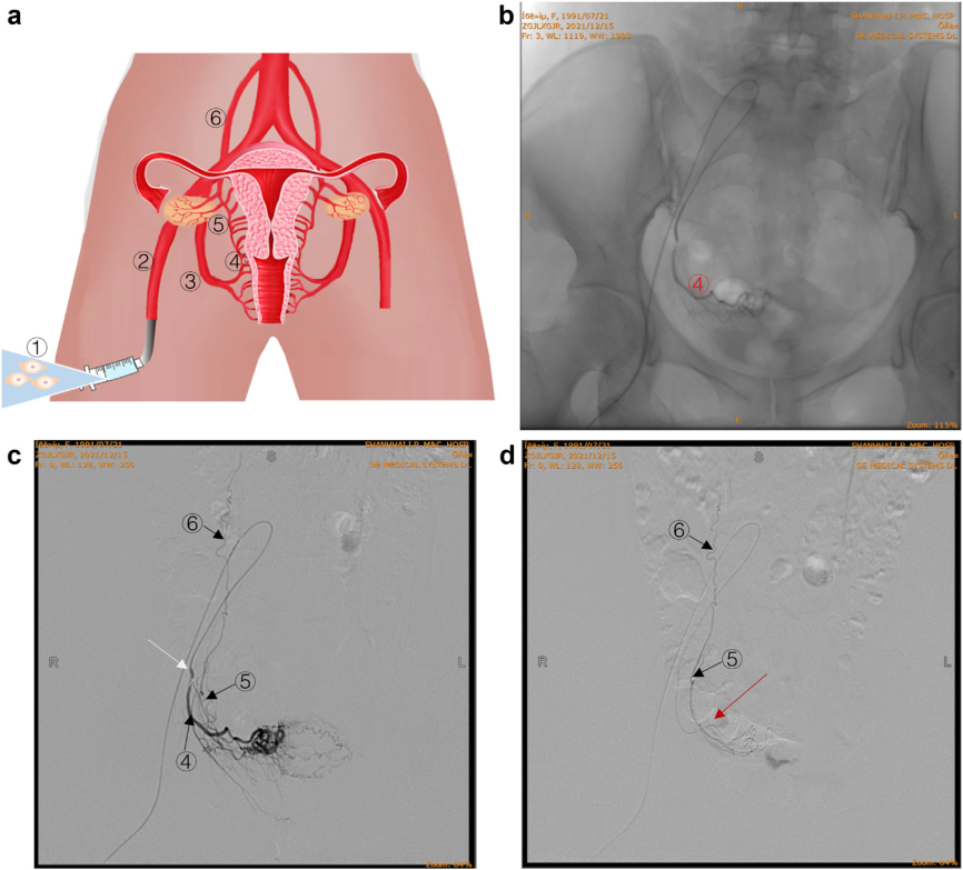 經(jīng)卵巢動(dòng)脈精準輸注hAEC