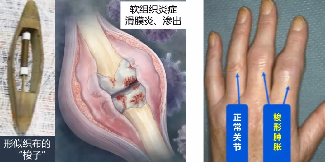 類(lèi)風(fēng)濕關(guān)節炎