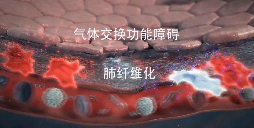 纖維化疾病