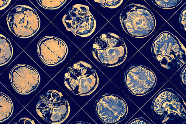 《神經(jīng)科學(xué)》雜志揭秘：iPSC療法治療帕金森病的療效與挑戰